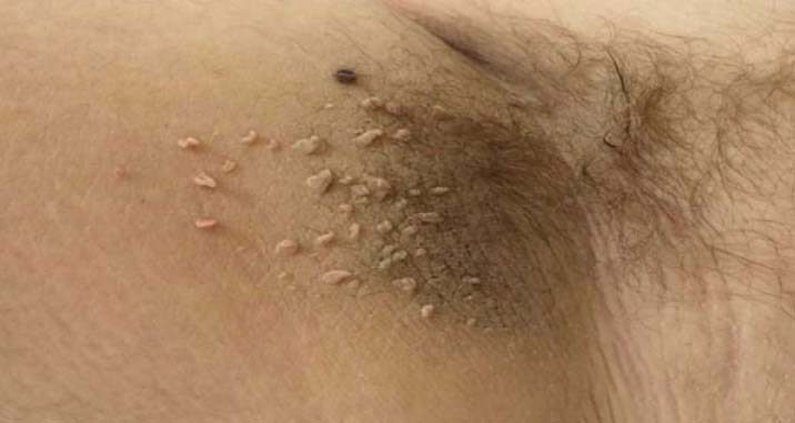 Mindenkinek van, de senki nem tudja eltávolítani könnyen. Ez a trükk egy csoda a szemölcsök ellen...