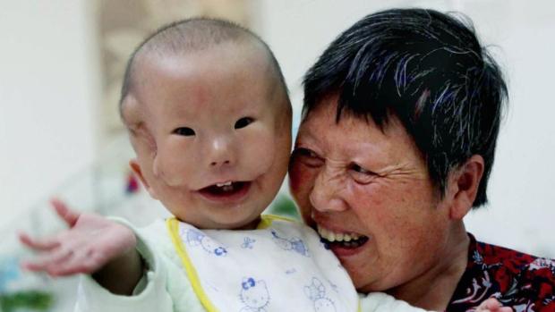 Szívbemarkoló szörnyű betegséggel született a kisfiú 3