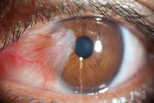 Esténként ezt tette, szemrákja lett, hamarosan belehalt! Így kerüld el ezt!