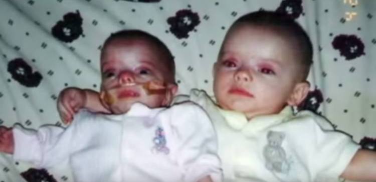 Az ikerpár egyik tagja születéskor nagyobb volt -az orvosok hat évvel később jönnek rá miért