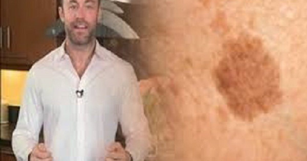 A híres bőrgyógyász elmondja a titkot: szabadulj meg a barna foltoktól, öregségi ráncoktól