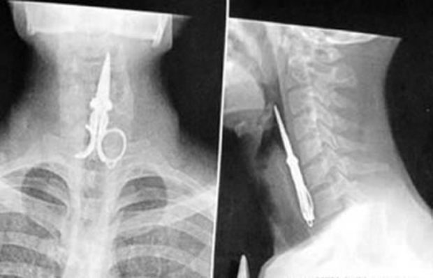 Elképesztő tárgyak az emberi testben Sokkoló röntgenelvételek! 2