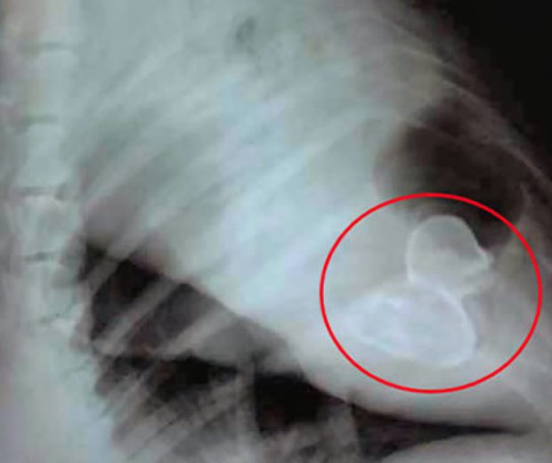 Elképesztő tárgyak az emberi testben Sokkoló röntgenelvételek! 3