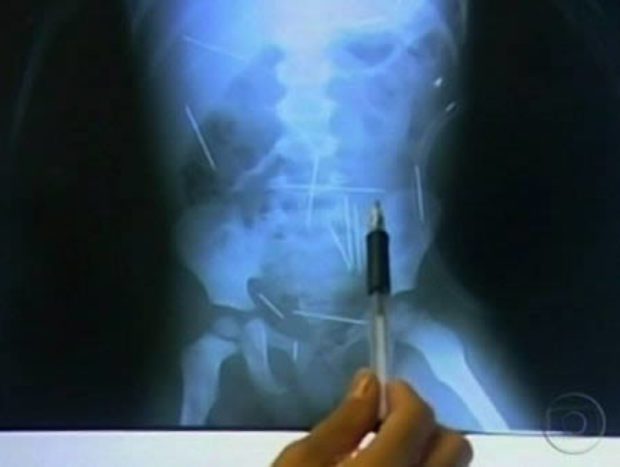 Elképesztő tárgyak az emberi testben Sokkoló röntgenelvételek! 4