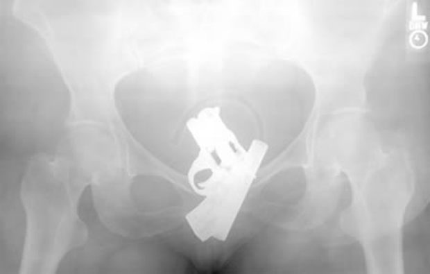 Elképesztő tárgyak az emberi testben Sokkoló röntgenelvételek!