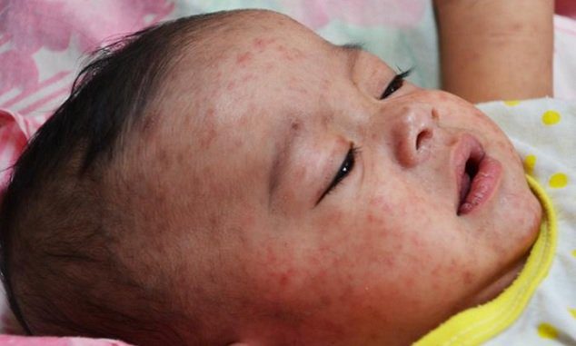 Tizenöt hónaposnál kisebbeknél a legveszélyesebb a kanyaró!