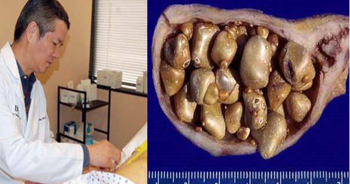 Egy kínai orvos felfedte a titkát, itt a legjobb módszer epekőre!