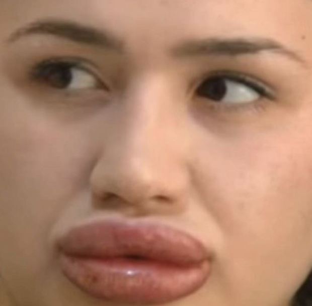 A fodrászát kérte meg, hogy töltse fel az ajkait durva, ami ezután történt 1