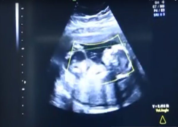 Csak a terhesség 41-ik hetében ment először orvoshoz… sokkot kaptak az orvosok attól, amit felfedeztek a hasában! 1