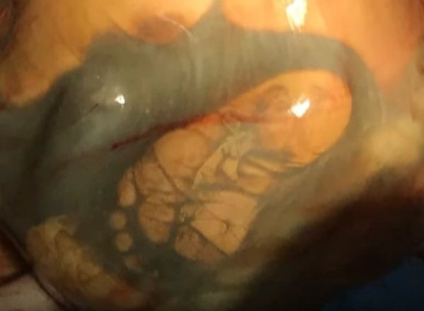 Csak a terhesség 41-ik hetében ment először orvoshoz… sokkot kaptak az orvosok attól, amit felfedeztek a hasában! 2