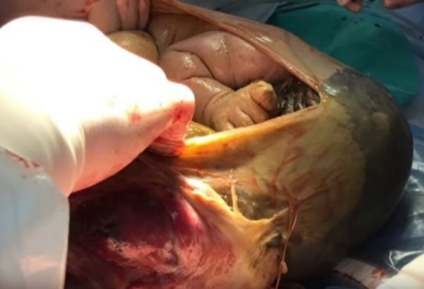 Csak a terhesség 41-ik hetében ment először orvoshoz… sokkot kaptak az orvosok attól, amit felfedeztek a hasában! 3