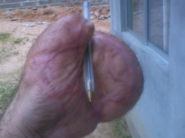 Elképesztő bravúrral mentették meg a gépkezelő széttrancsírozott kezét 2