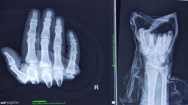 Rettenetes baleset ért egy magyar munkást Ausztriában