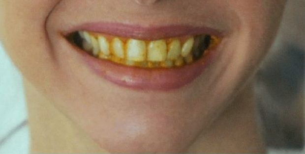 Elképesztő módszerrel lesz ragyogóan fehér a fogad 2