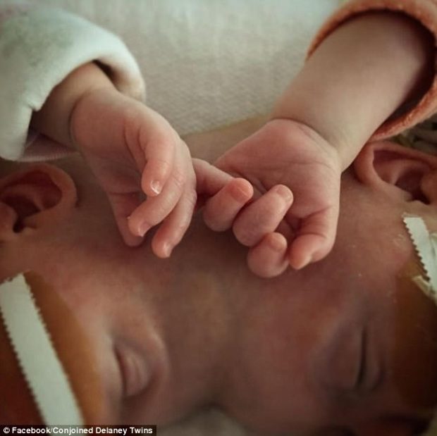 Orvosi csoda! Sikeresen szétválasztották a fejüknél összenőtt sziámi ikreket 1