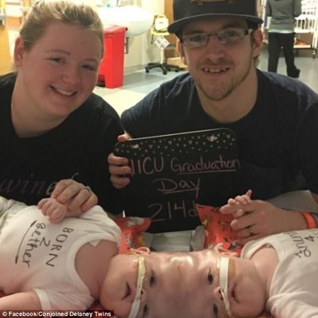 Orvosi csoda! Sikeresen szétválasztották a fejüknél összenőtt sziámi ikreket 2