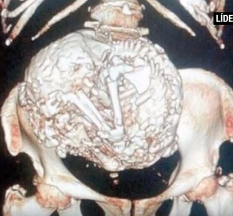 50 évig nem vette észre, hogy terhes