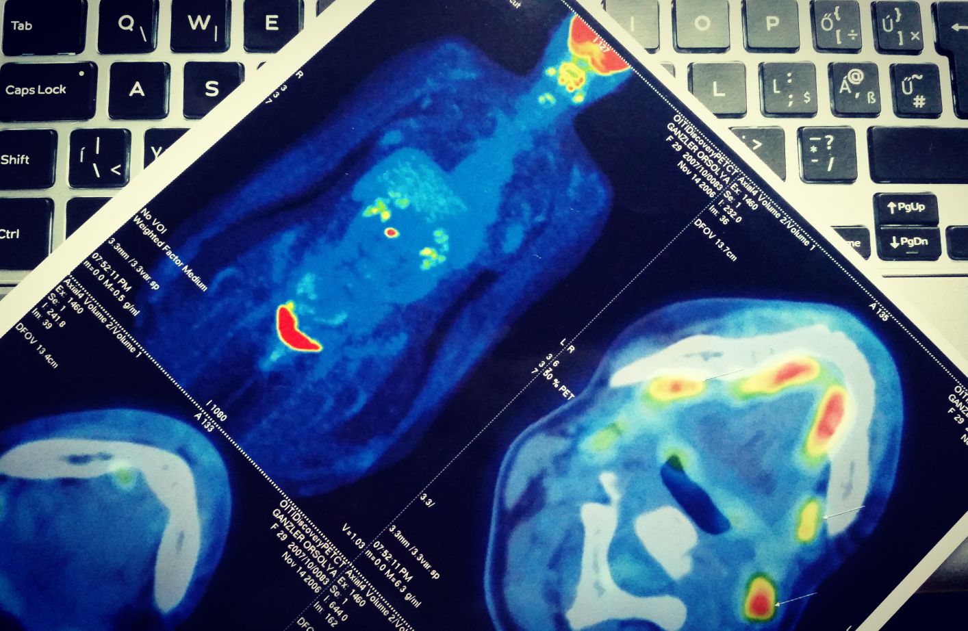 A diagnózis nyirokrák. Kolléganőnk története bizonyítja, a kór legyőzhető 1
