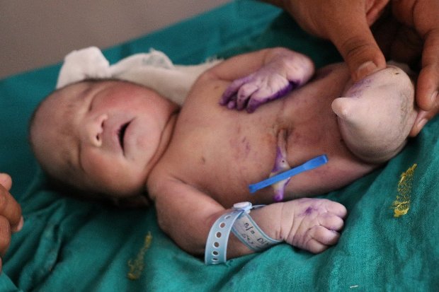 Mindössze 15 percet élt az összenőtt lábakkal született sellőbaba 1